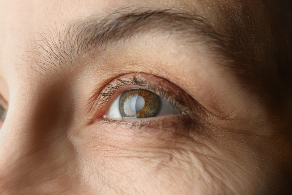Close-up of an eye showing the clouded lens of a cataract