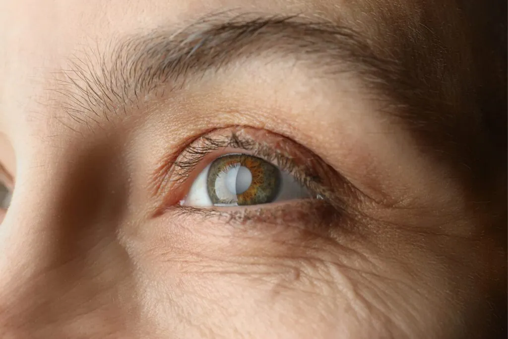 A close, clinical view of the eye during a cataract assessment at STOTTS.