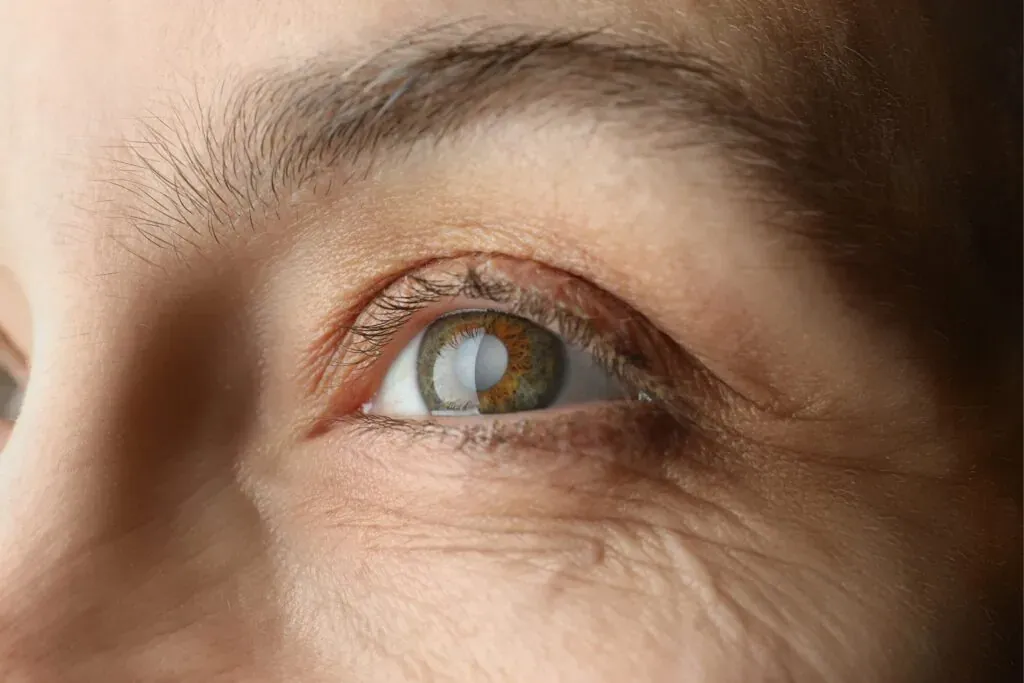 What is a cataract, and when should it be treated?